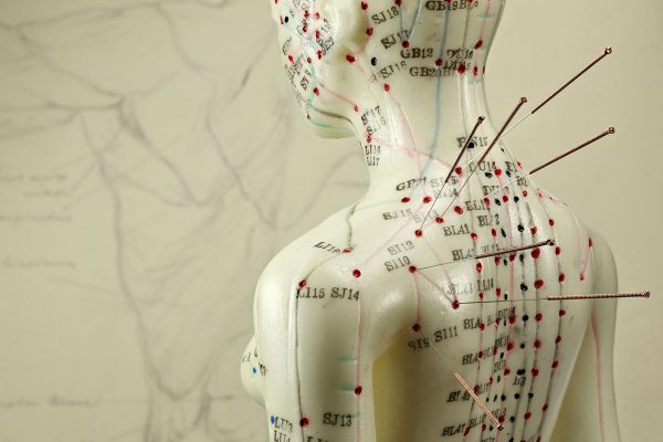 female acupuncture model with needles in the shoulder