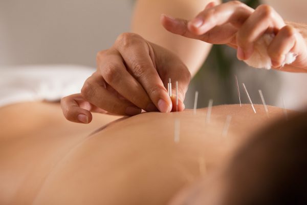 The doctor sticks needles into the girl's body on the acupuncture - close up